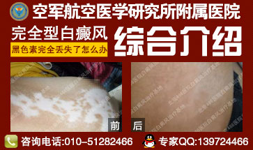 怎样进行白癜风的预防工作 怎样进行白癜风的预防工作