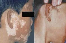 初期白癜风能治愈吗?